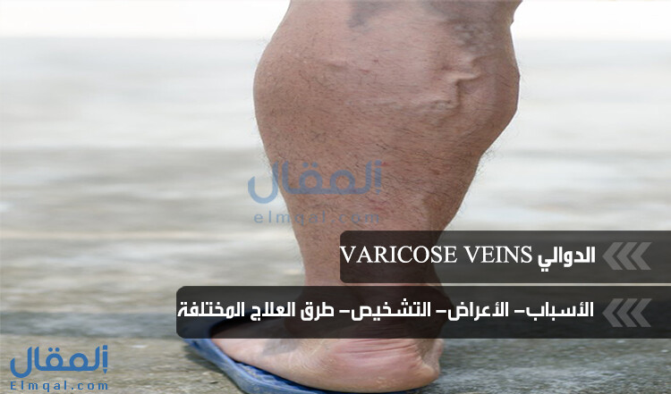 أسباب الإصابة بالدوالي Varicose veins وكيفية الوقاية منها