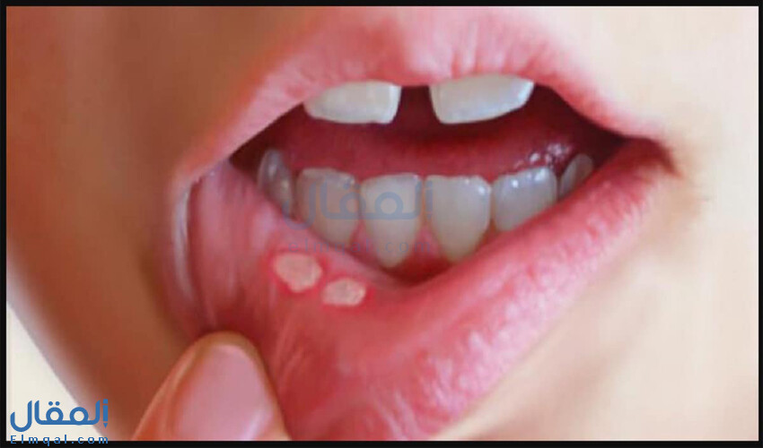 علاج تقرحات الفم وأعراضها ونصائح للوقاية منها