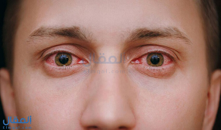 إحمرار العين: الأسباب والأعراض والعلاج ونصائح للوقاية منه