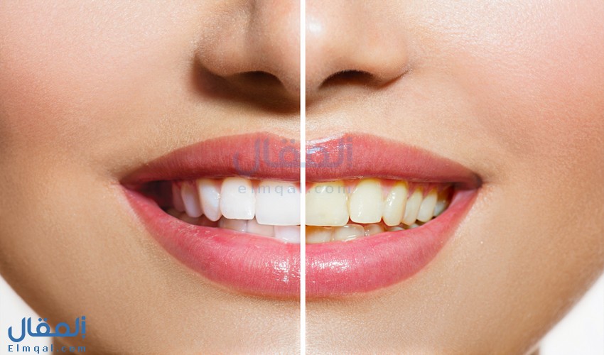 الأسباب التي تؤدي إلى اصفرار الأسنان وكيف يمكنك تجنبها؟