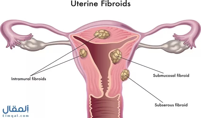 ألياف الرحم عند النساء 4 أنواع ما هي