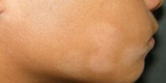 9 أسباب لظهور بقع الجلد البيضاء في الوجه واليد